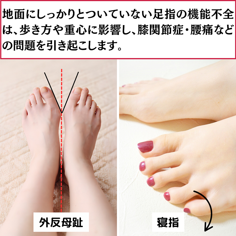 外反母趾は、身体の中心線から見て母趾が外側に向いている状態です。一方、寝指は、歩行の癖や足指の筋力不足によって小指が横に曲がっている状態です。