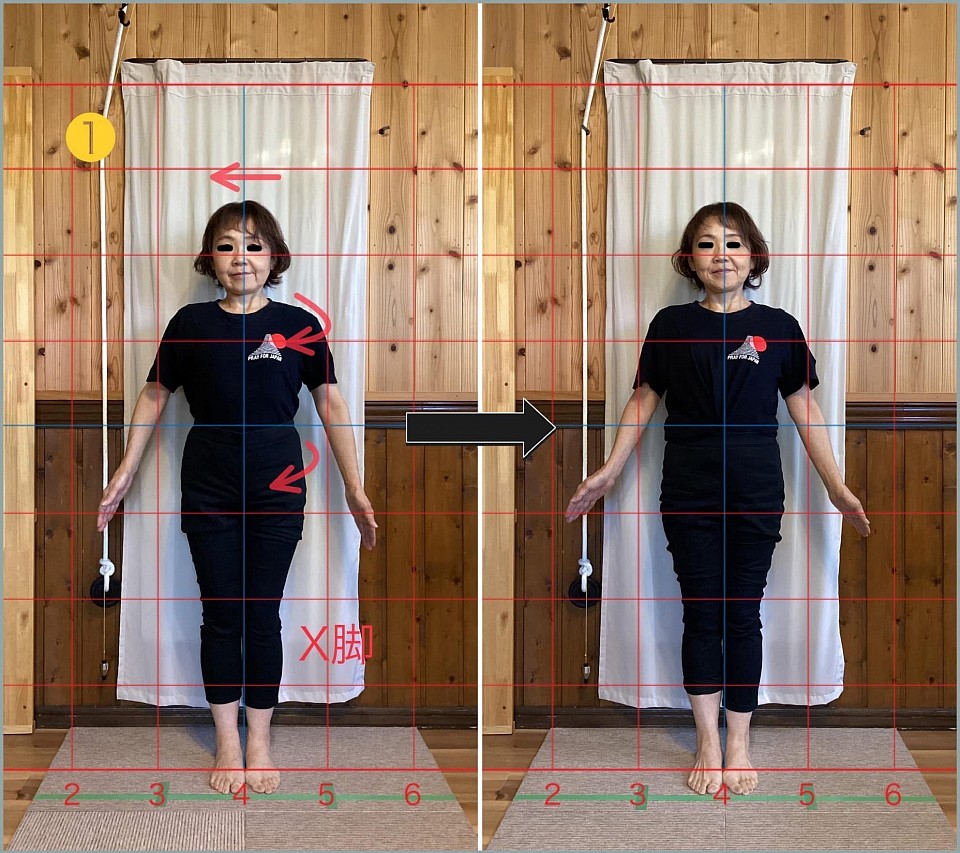 1. ビフォーアフター写真（前面）：ややX脚で右側に捻れ（巻き肩ではありません）が認められた部位の変化です。