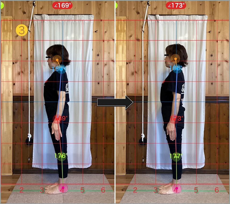 3. ビフォーアフター写真（左側面）：理想は180°ですが、大転子の角度が青いライン付近で169°から173°へと改善しました。