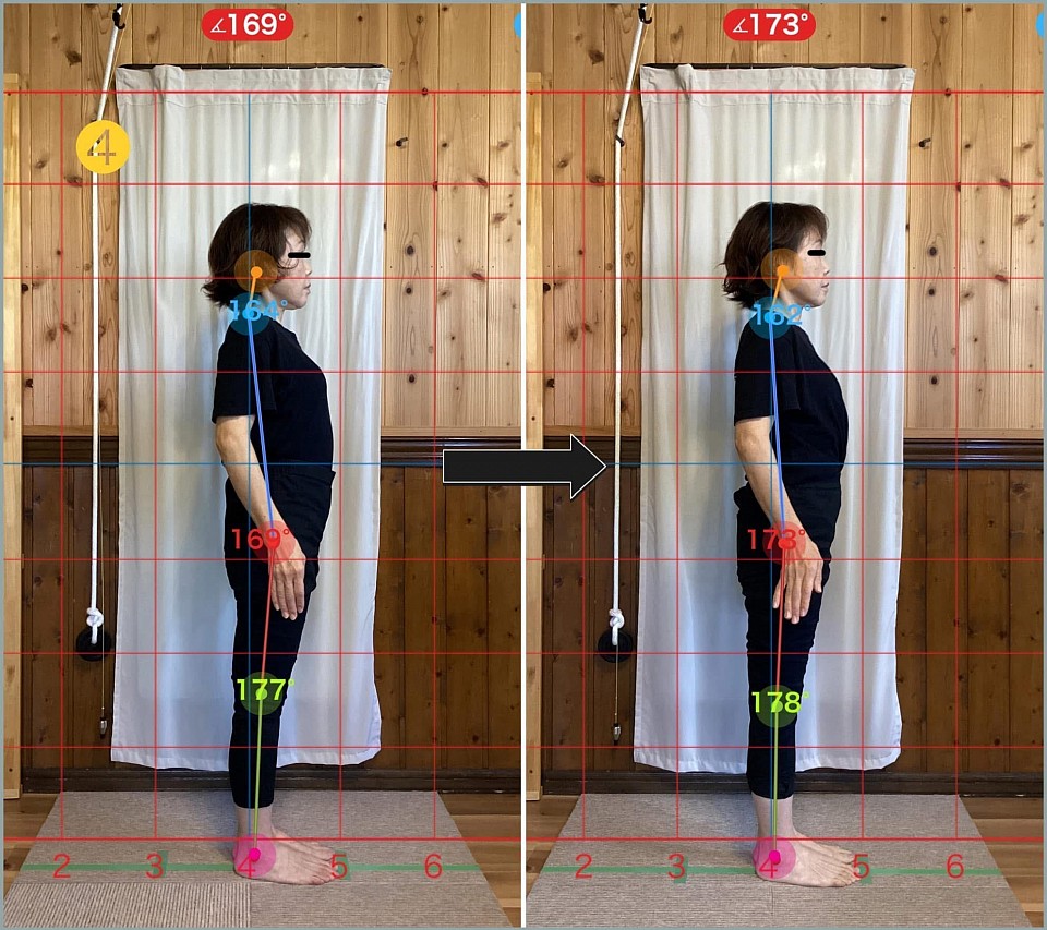 4. ビフォーアフター写真（右側面）：お客様は右肘に骨折および手術の既往があり（伸展困難な状態）、本来は肘を青いラインに合わせることが理想ですが、こちらも169°から173°へと変化しています。また前重心から変わっています。（動画もございます）