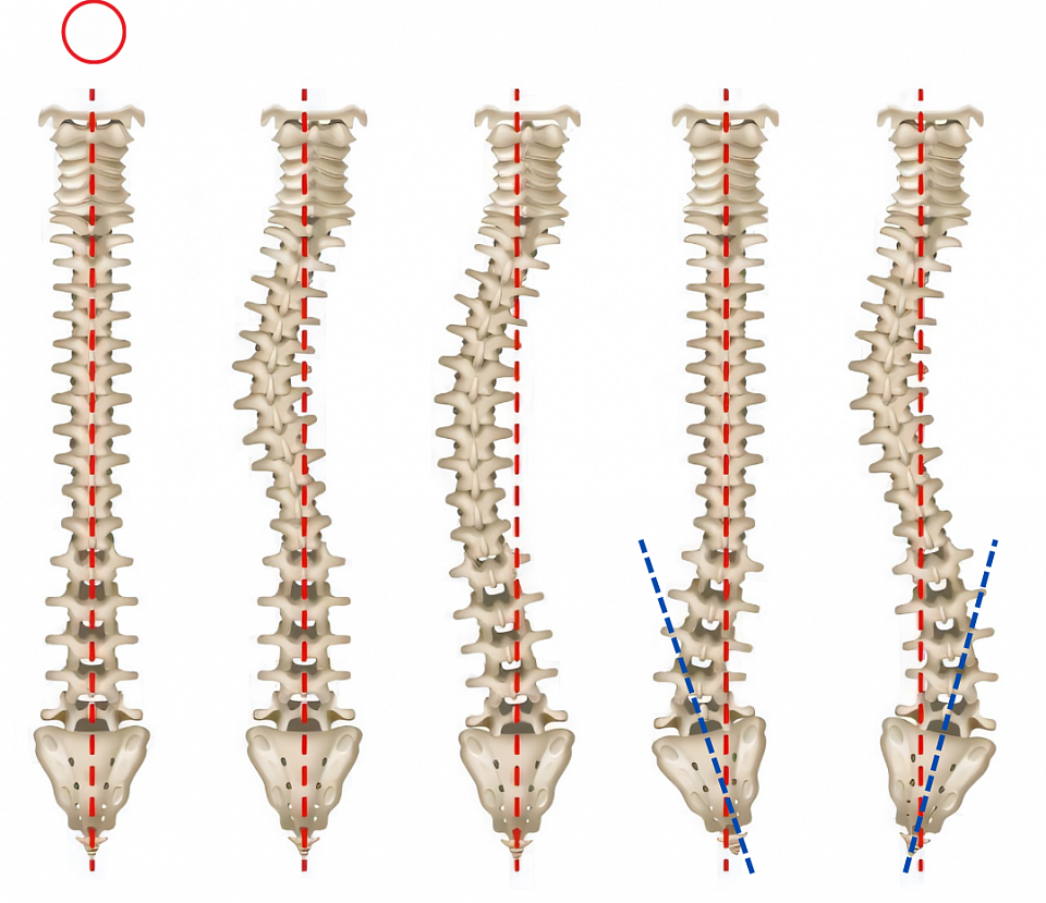 右側の一番や二番は仙骨が傾いています。その後、仙骨矯正（骨盤矯正）を行い、左側の正常な背骨へと整えていき、身体は締まったり変わります。