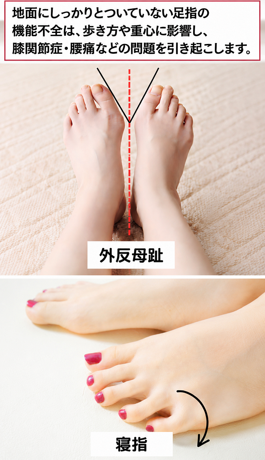 外反母趾は、身体の中心線から見て母趾が外側に向いている状態です。一方、寝指は、歩行の癖や足指の筋力不足によって小指が横に曲がっている状態です。
