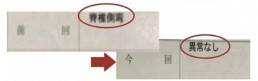 健康診断の判定が「脊柱側弯」から「異常なし」へ変化した臨床例