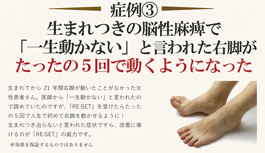 脳性麻痺による右脚の変化を示した臨床例