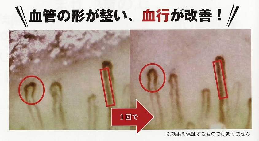 たった一回の施術で血流に見られた変化